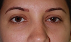1 Eyebrow - Before
