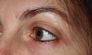 3 Eyebrow - Before
